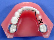 Orthodontic space maintainer