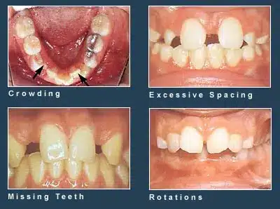 Different types of orthodontic problems