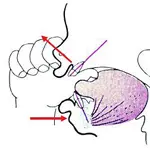 Diagram of thumbsicking causing problems in orthodontic patients