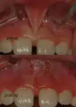 Before and After Frenectomy surgery